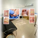 Tırnak Batması – Batık Tırnak