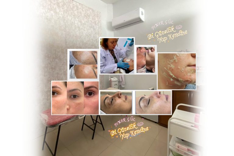 Yosun Peeling Yenikent Güzellik Merkezi Pınar Gül