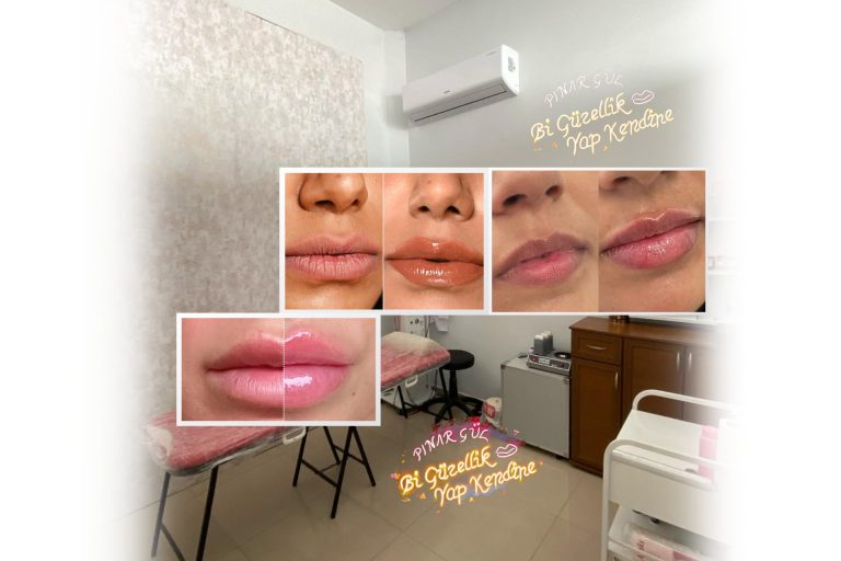 Yenikent Dudak Vitamini