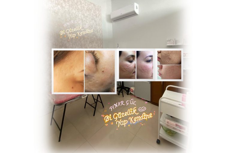 PRP Cilt Yenileme Leke Giderme