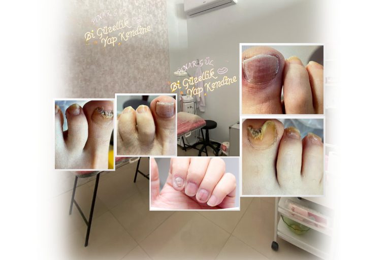 Tırnak Mantarı Yenikent Güzellik Merkezi Pınar Gül