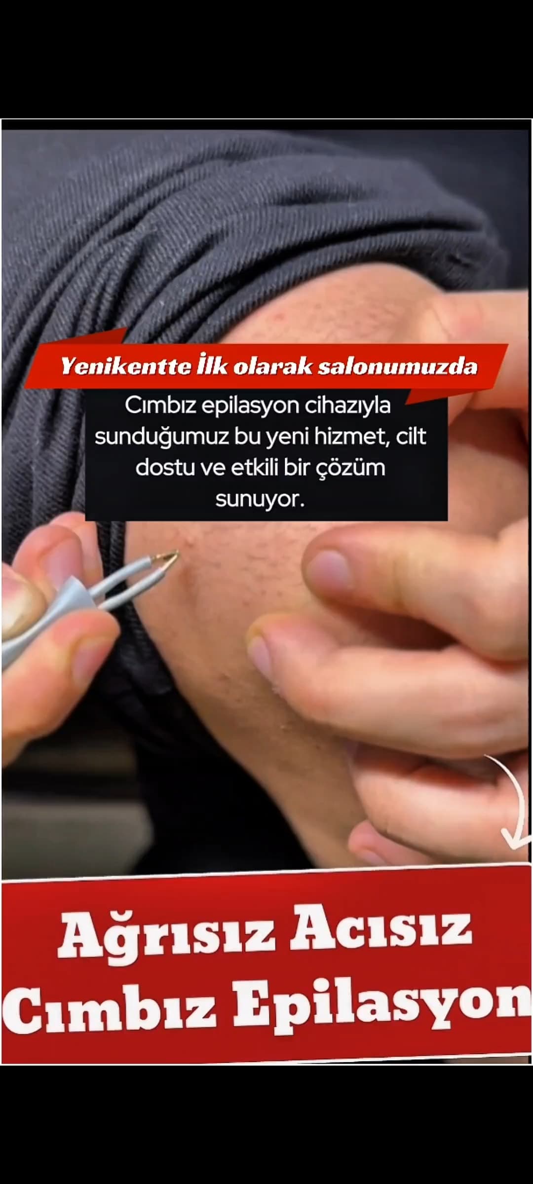 cımbız epilasyon yenikent 0533 479 66 81