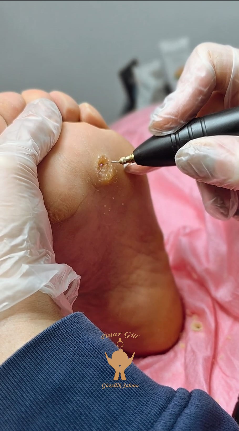 ayak bakımı nasır